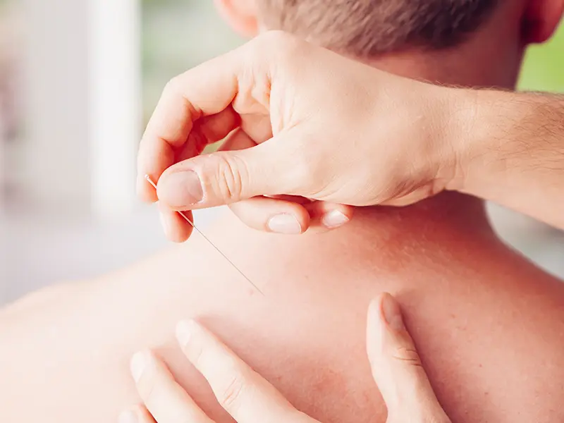 Akupunktur
