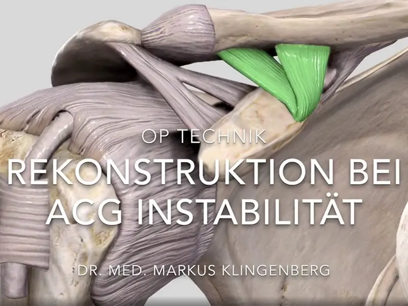 Rekonstruktion des Schultereckgelenks